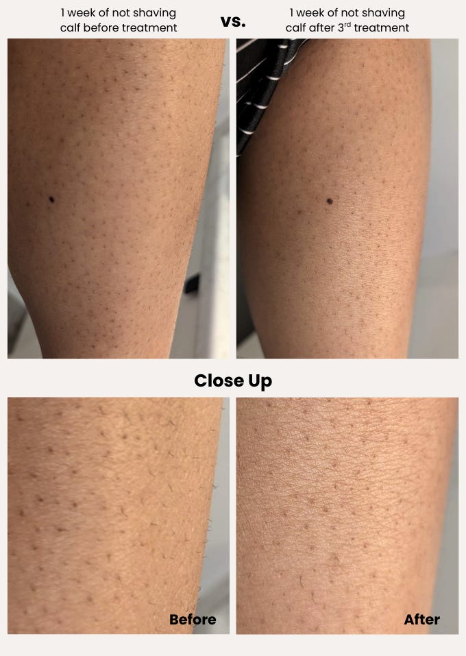 ViQure S-LD Before and After Results