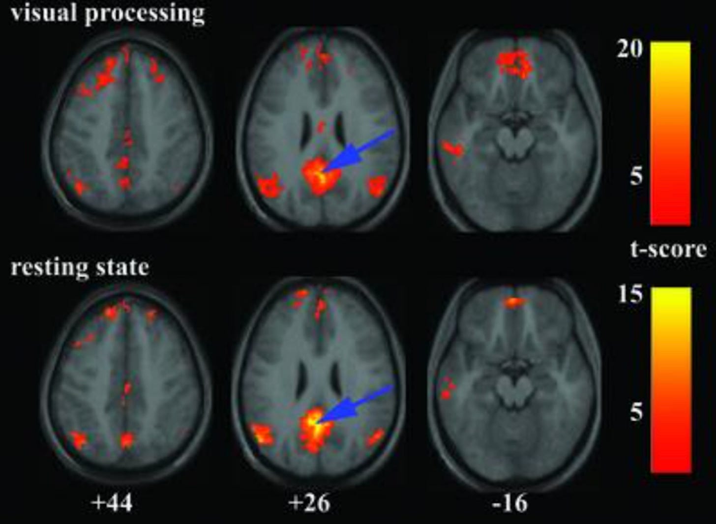 Figure 4. [Greicius et al. (2003)] “Comparison of the PCC connectivity patterns during the visual processing task (Upper) and the resting-state (Lower). The blue arrows indicate the approximate location of the PCC peak […]”