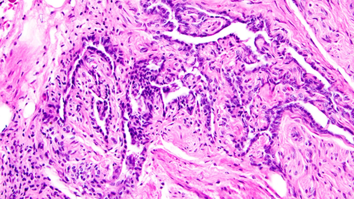 A microscope image of the tissue in the rete ovarii A microscope image of the tissue in the rete ovarii