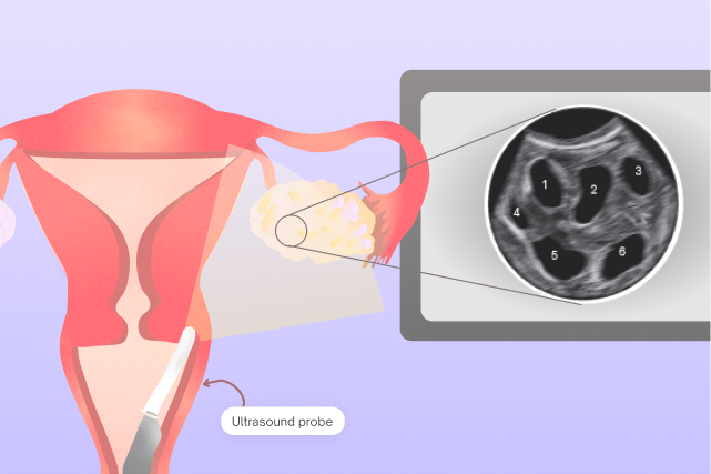 What is Antral Follicle Count (& Why it Matters for Egg Freezing)