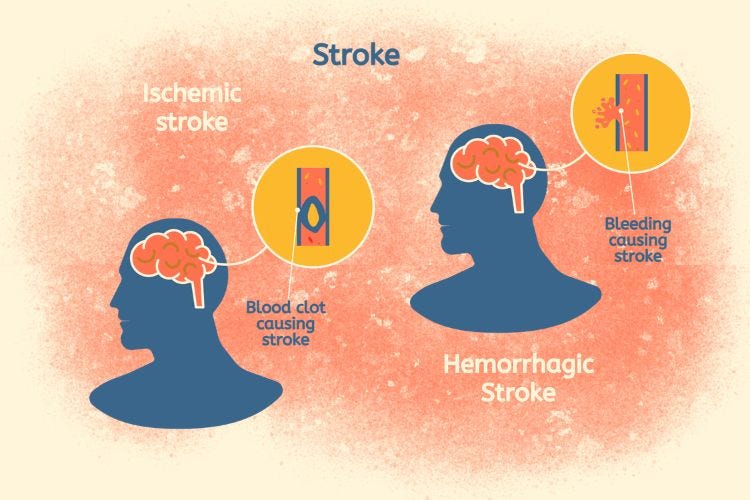 Stroke