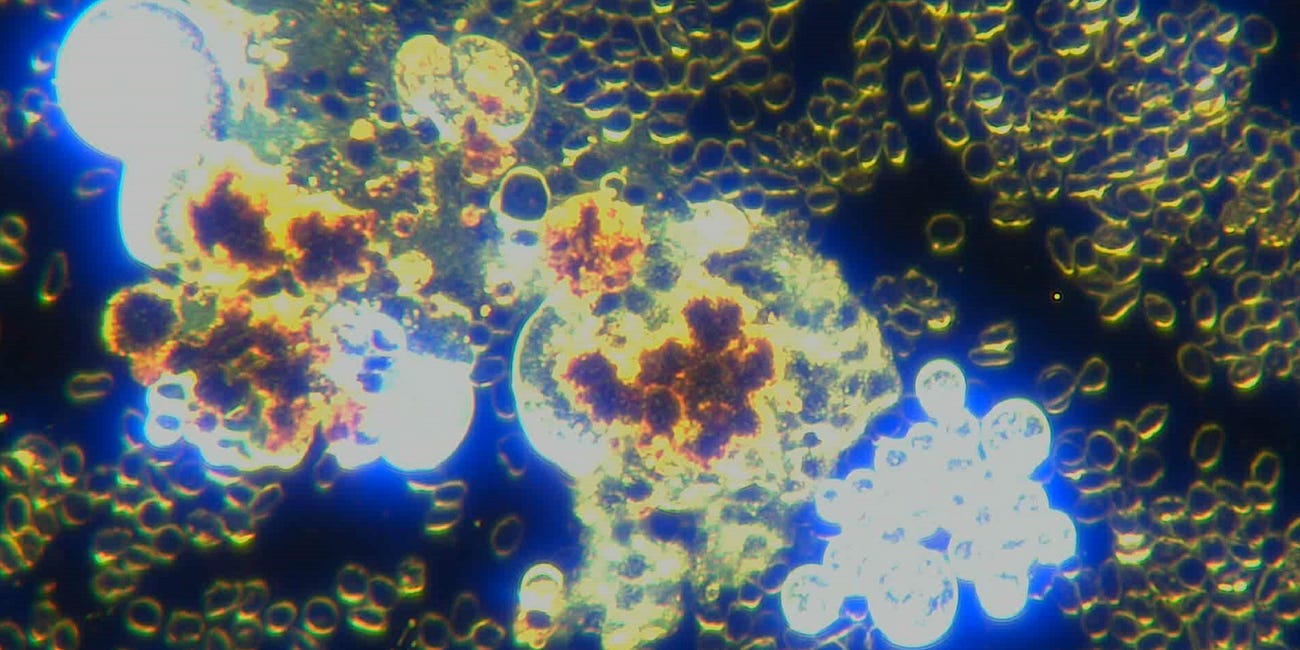 Same Self Replicating Nanotechnology Spheres Seen In C19 Unvaccinated Living Blood As In Deceased Embalmed C19 Vaccinated Blood With Rubbery Clots - What Will Humanity Do About This?