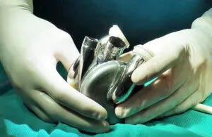 BiVacor total artificial heart