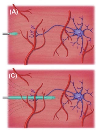 injeção anterograda