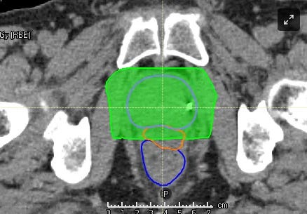 protons 101 storey prostate USPT proton