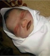 Gray baby syndrome ) due ...