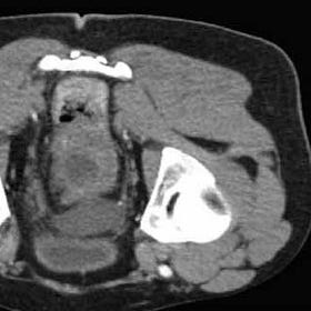 Case Report: Plasmacytoid Urothelial Cancer, age 54, Male
