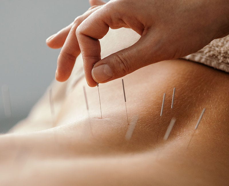 Acupuncture: What To Know Acupuncture: What To Know