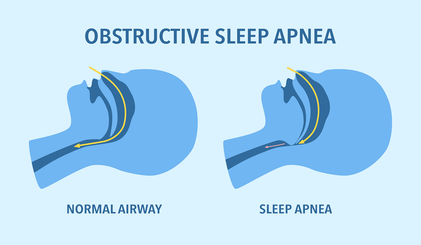 New Technology for Treating Sleep Apnea | St. Luke's Ear, Nose and Throat  Associates | Inspire Device