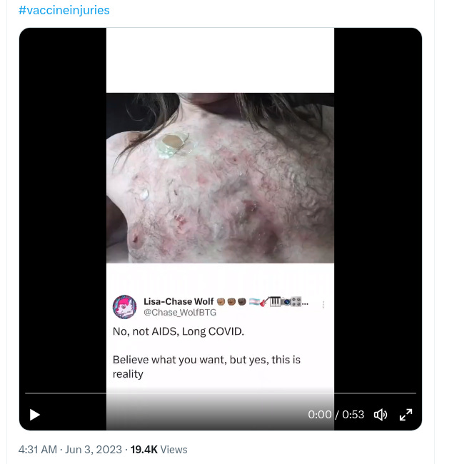 This Is What Total Destruction of the Immune System by mRNA Nanoparticle Bioweapon Looks Like…