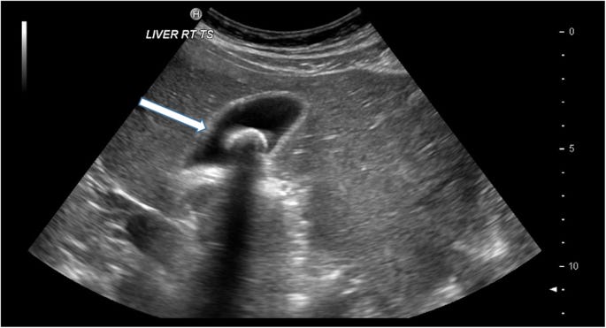 gallbladder ultrasound images