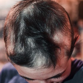 THEY LIED: Hair Loss Linked to COVID 'Vaccines' in Explosive New Study