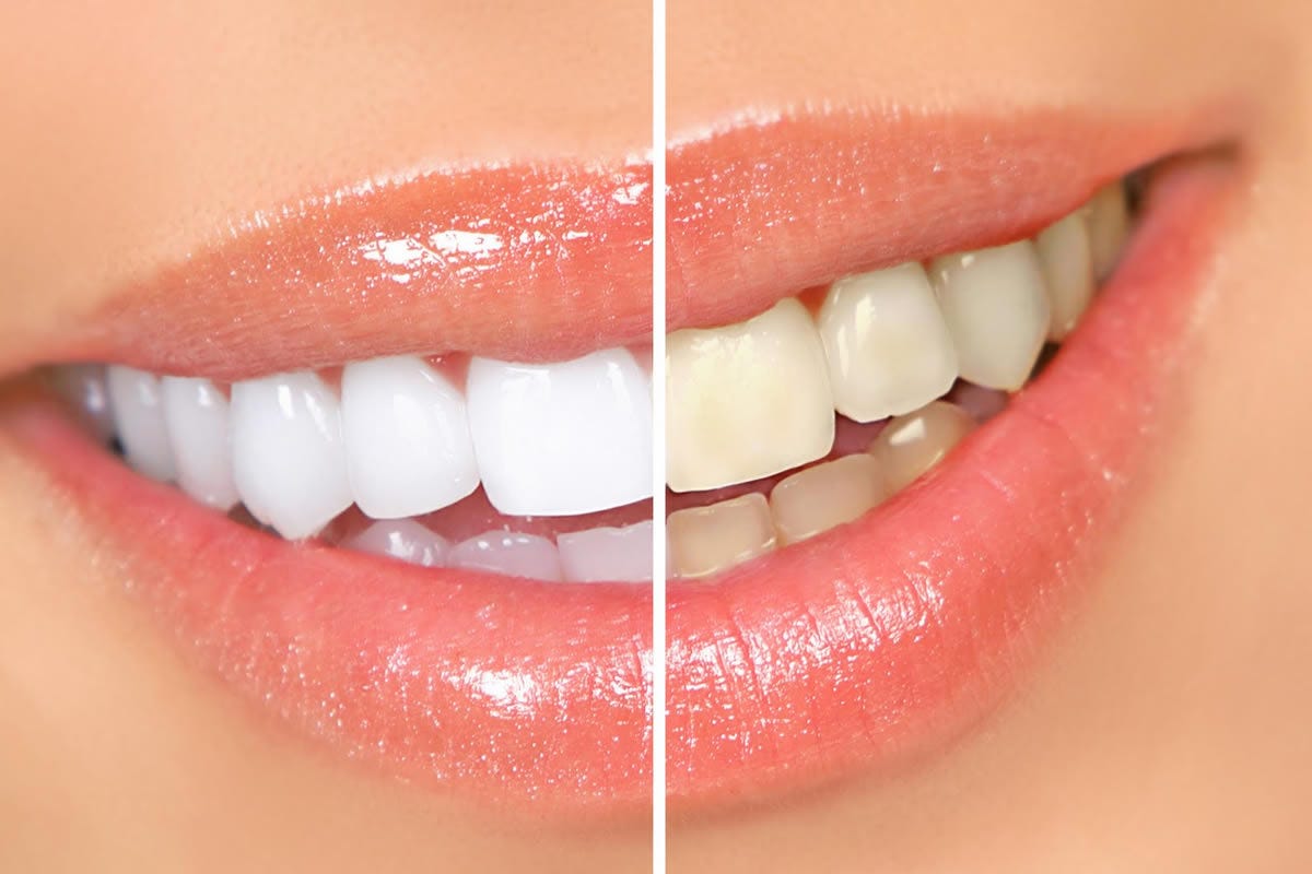 Mitos e verdades sobre o Clareamento Dental | Odonto Empresas