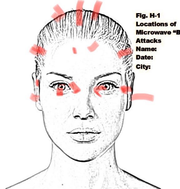 Microwave attacks to the Head