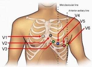 precordial-lead-placement
