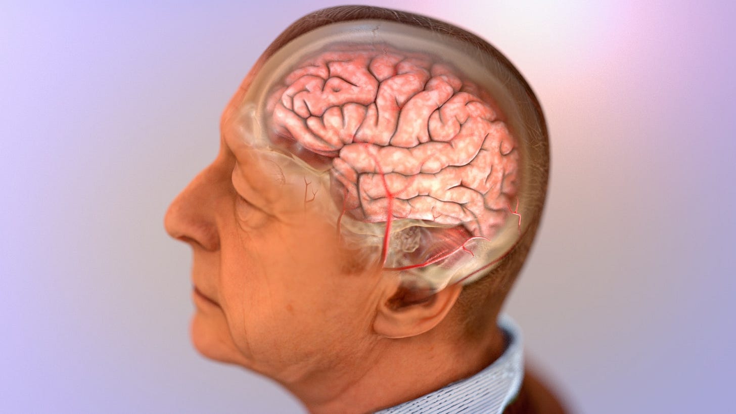 An older man’s brain and its blood vessels. An older man’s brain and its blood vessels.