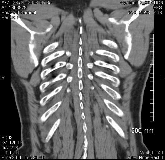 Cat scan