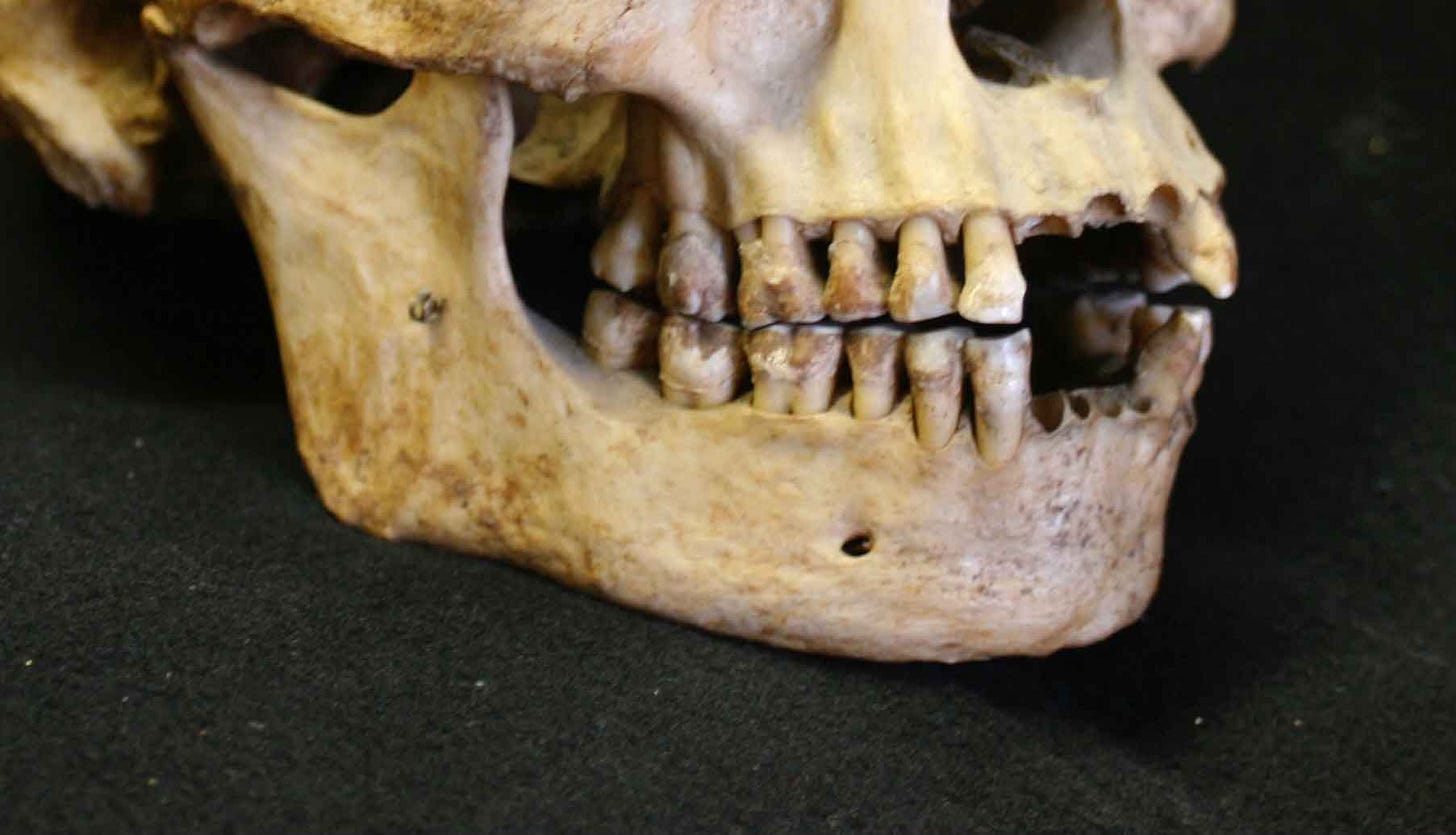 Mandible and lower face of a skeletal individual showing small chin