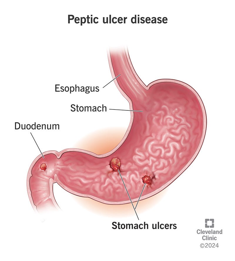 Peptic Ulcer Disease: Symptoms, Causes, Treatment & Medication