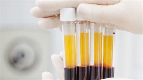 Treating coronavirus: How blood plasma from recovered patients may help