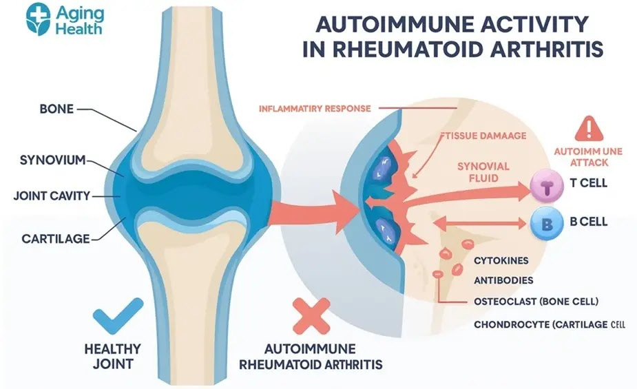 Autoimmune Rheumatoid Arthritis Diagram illustrating the autoimmune response in rheumatoid arthritis, highlighting affected joints and immune system interactions.