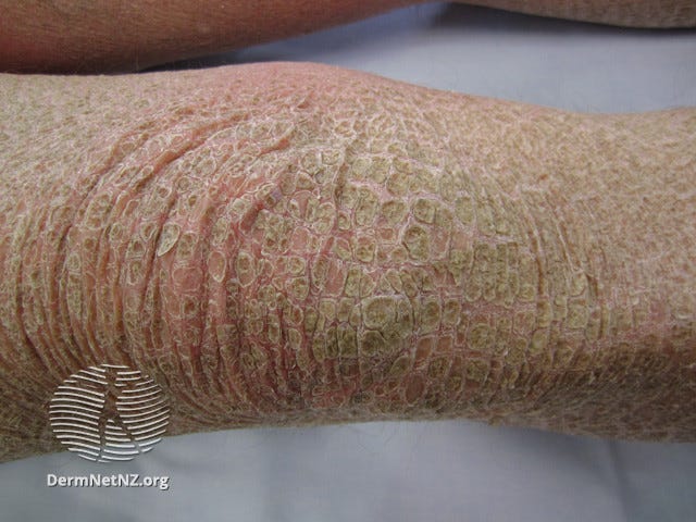 Picture of someone’s elbow with very flaky and scaly skin