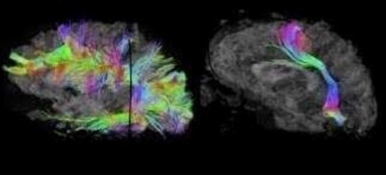 Slide 1 – showing two very different brain scans side by side. One shows neurons traveling in a nice orderly path, the other looks like a disco ball