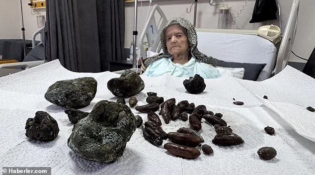 Surgeons removed 28 date seeds and 35 olive pits as well as five fist-sized rock-like masses from her stomach and small intestine Surgeons removed 28 date seeds and 35 olive pits as well as five fist-sized rock-like masses from her stomach and small intestine