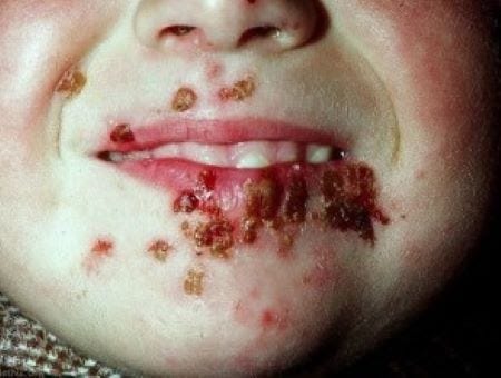 The Federalist: Covid Vaccine Triggering Herpes Infections The Federalist: Covid Vaccine Triggering Herpes Infections