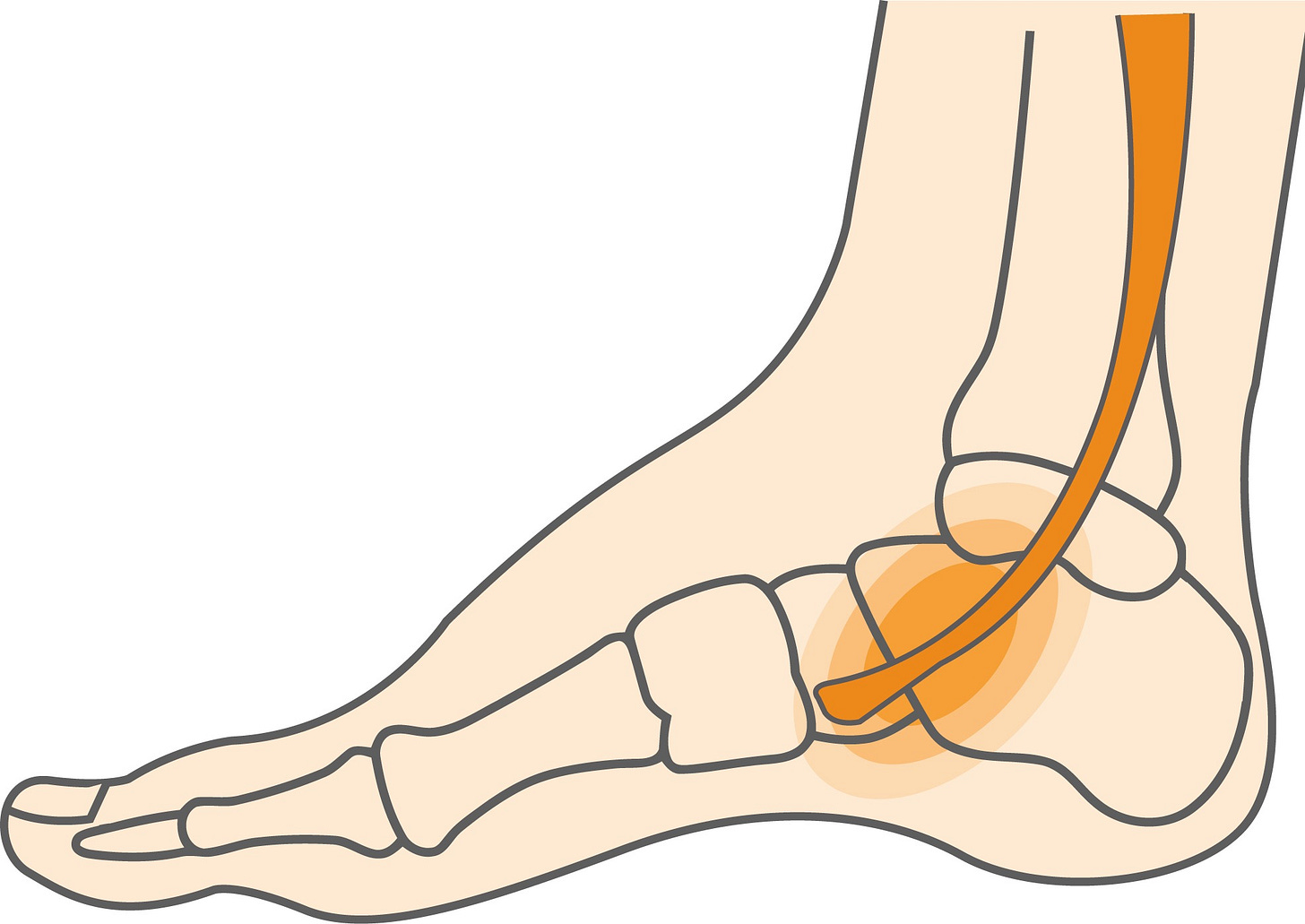 Posterior Tibial Tendonitis Hero Image