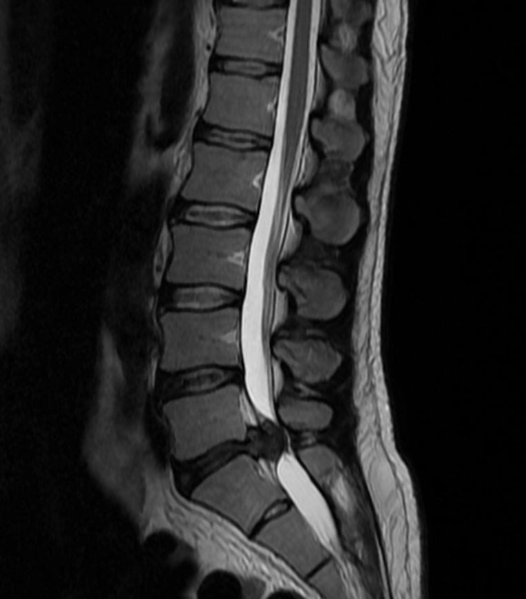 Cauda Equina Syndrome - Spine - Orthobullets
