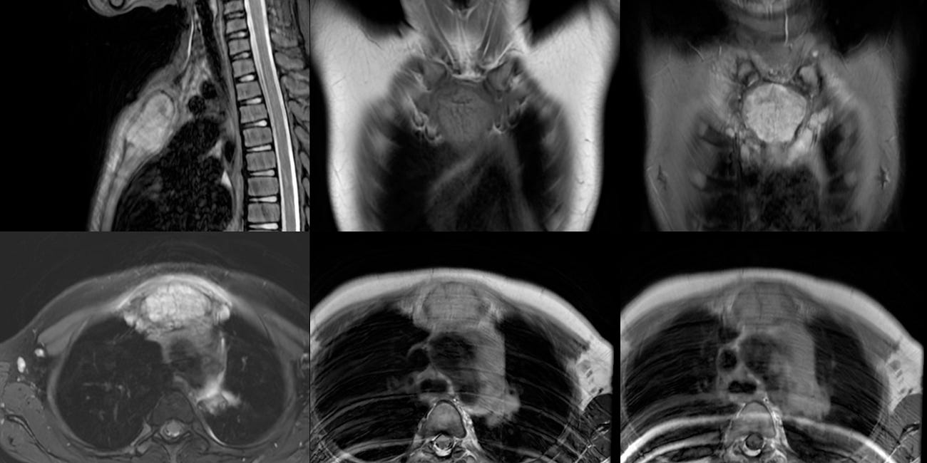 Case 59: Spina Ventosa is More than Just Dactylitis