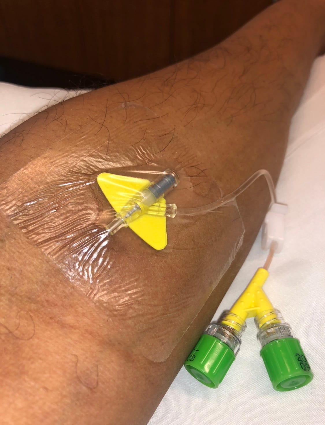 Close-up of my arm during cancer treatment with a PICC line and two visible lumens, reflecting the reality of my stem cell transplant recovery.