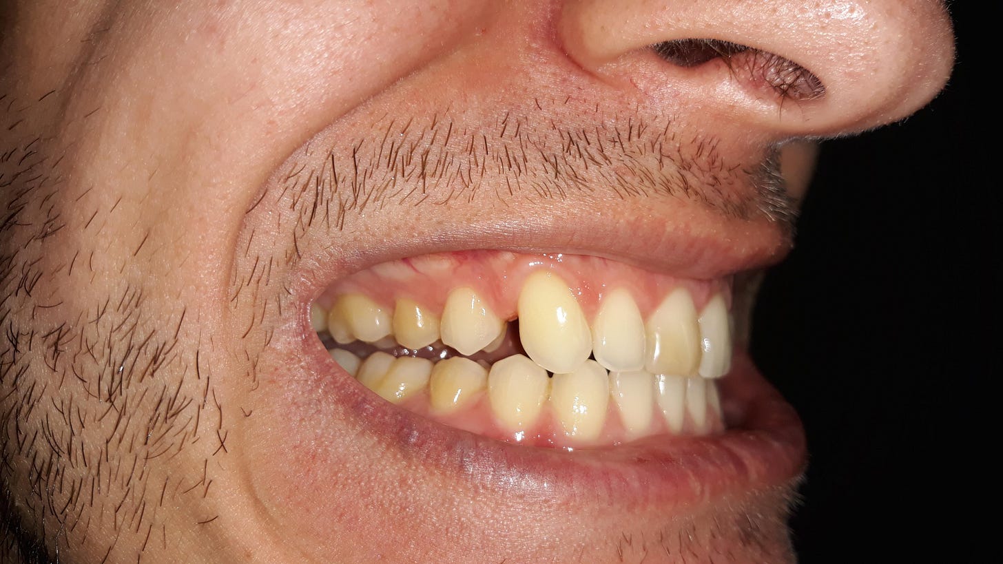 Posterior open-bite : r/askdentists