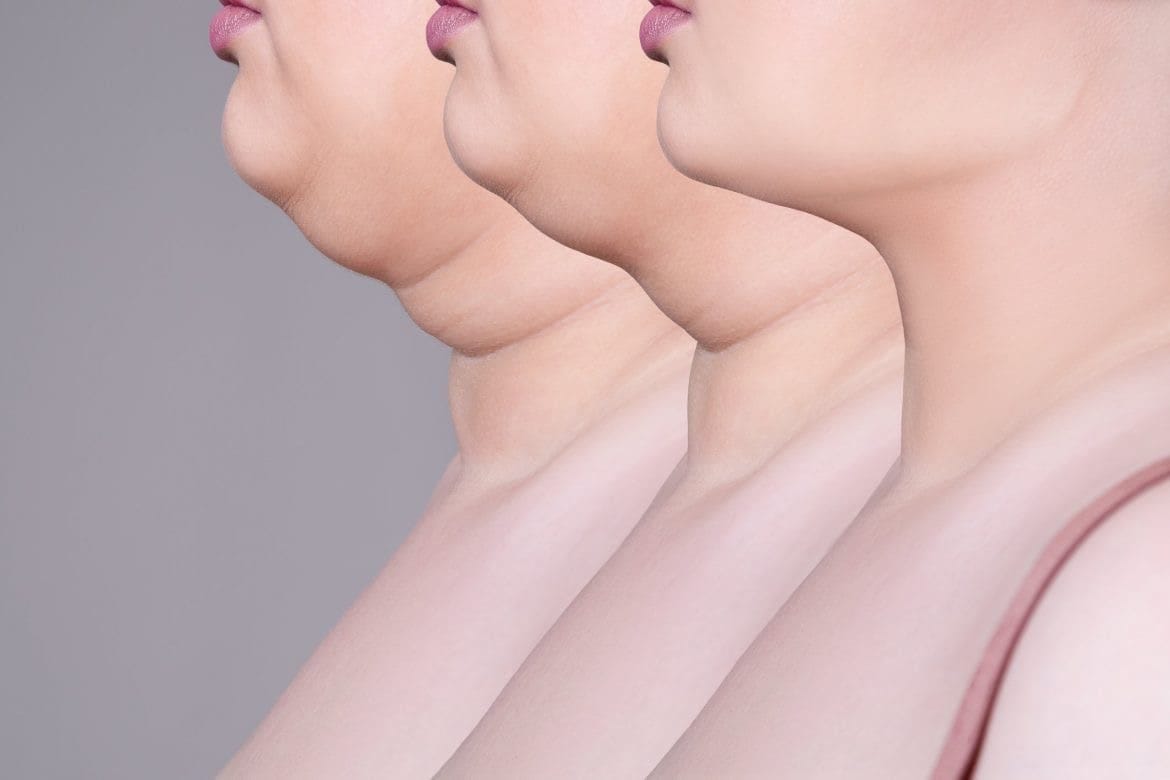 Eliminate the Extra: A Guide to Double Chin Causes and Cures