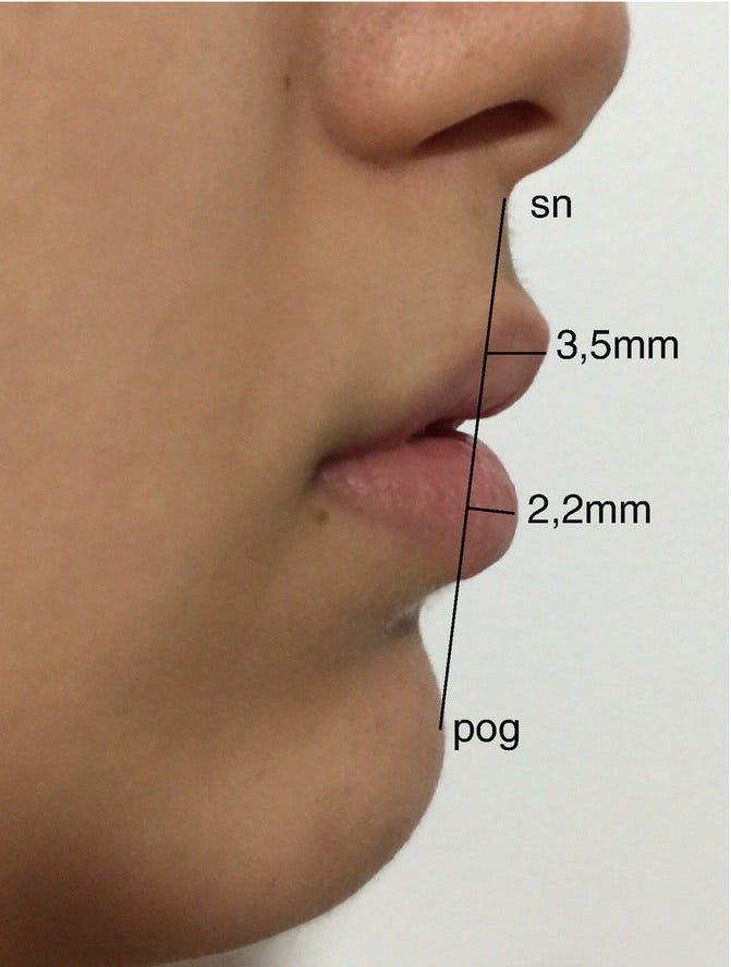 Perfiloplastia, harmonização facial