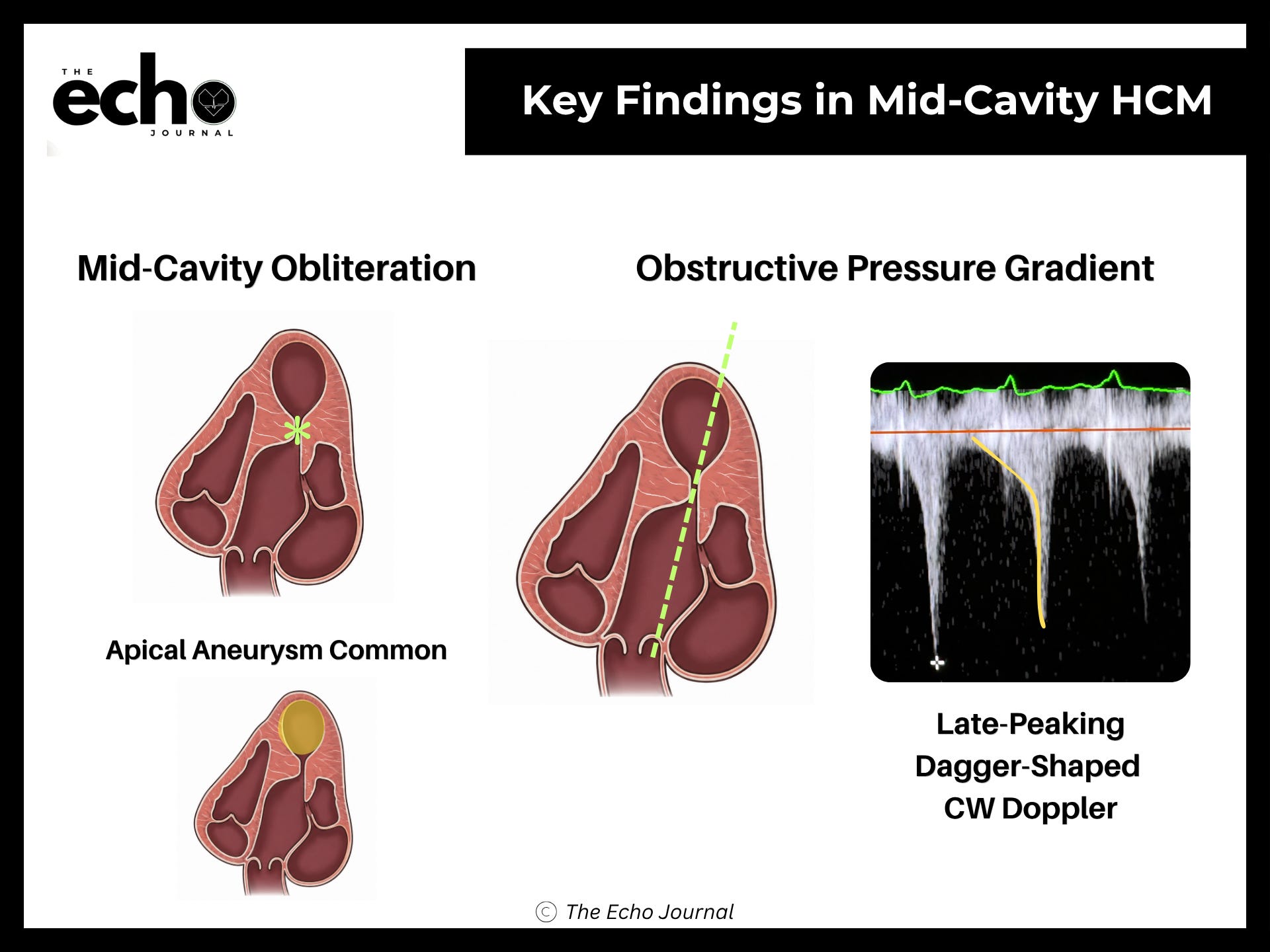 Hcm Chart The HCM Variants Most Sonographers Misclassify — And How to Tell Them Apart