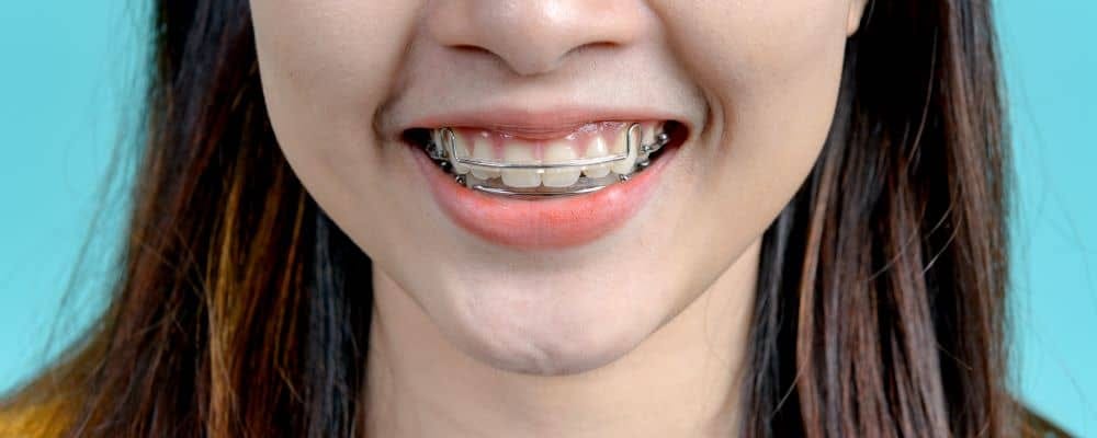 Retainers: How to Maintain Your Straight Teeth - Oasis ...