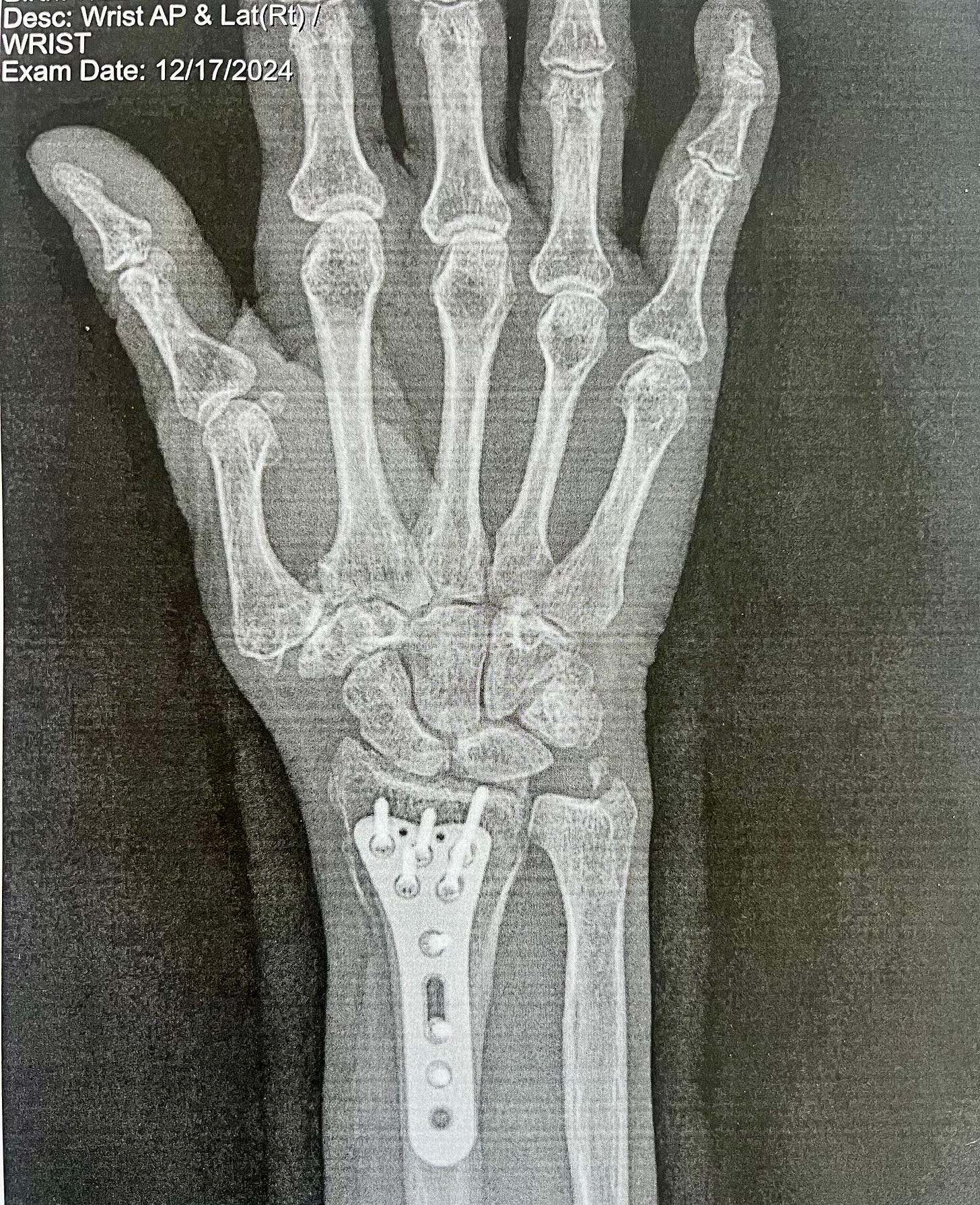 broken wrist with plate and screws xray from pickleball injury broken wrist with plate and screws xray from pickleball injury