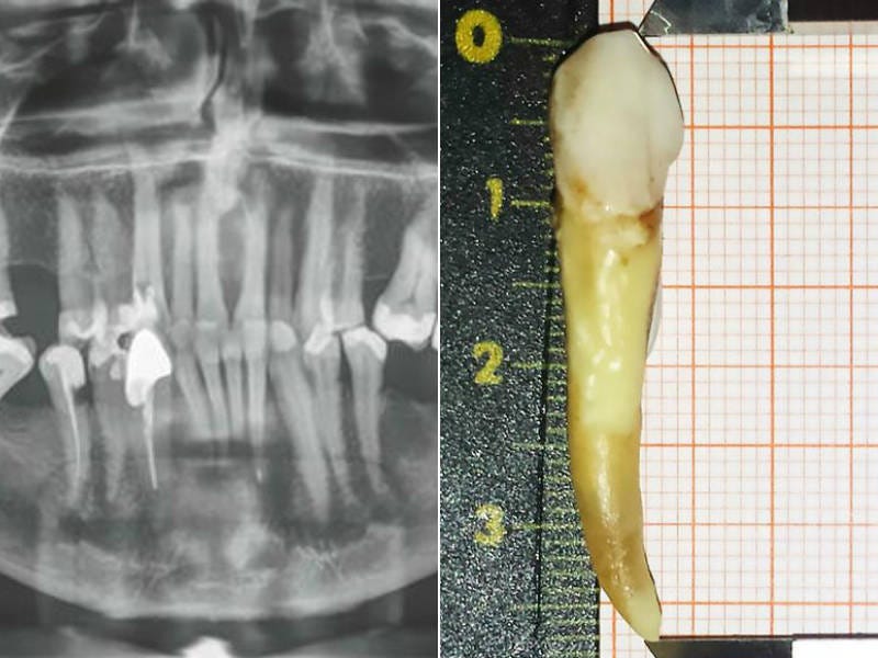 Dentista extrai o maior dente humano já registrado na história - Fotos - R7  Hora 7