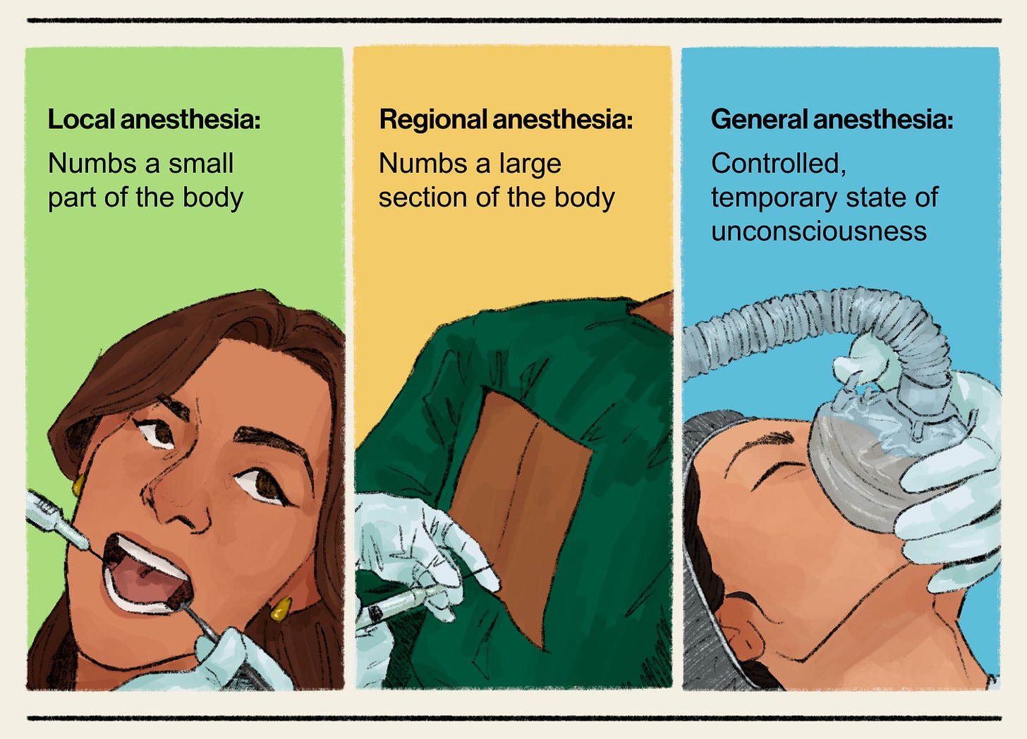 An ​illustration divided into three vertical panels, each explaining a different type of anesthesia​. They include, from left to right: Local anesthesia (Green panel)​. The text reads, "Numbs a small part of the body." The illustration shows a medical professional’s gloved hand administering an injection into a patient’s open mouth, likely for a dental procedure​. Regional anesthesia (Yellow panel)​. The text reads, "Numbs a large section of the body." The illustration shows a medical professional administering an injection into the lower back of a patient wearing a green hospital gown​. General anesthesia (Blue panel)​. The text reads, "Controlled, temporary state of unconsciousness." The illustration shows a patient with their eyes closed while a gloved hand holds an anesthesia mask over their nose and mouth.