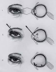 Cataract couching