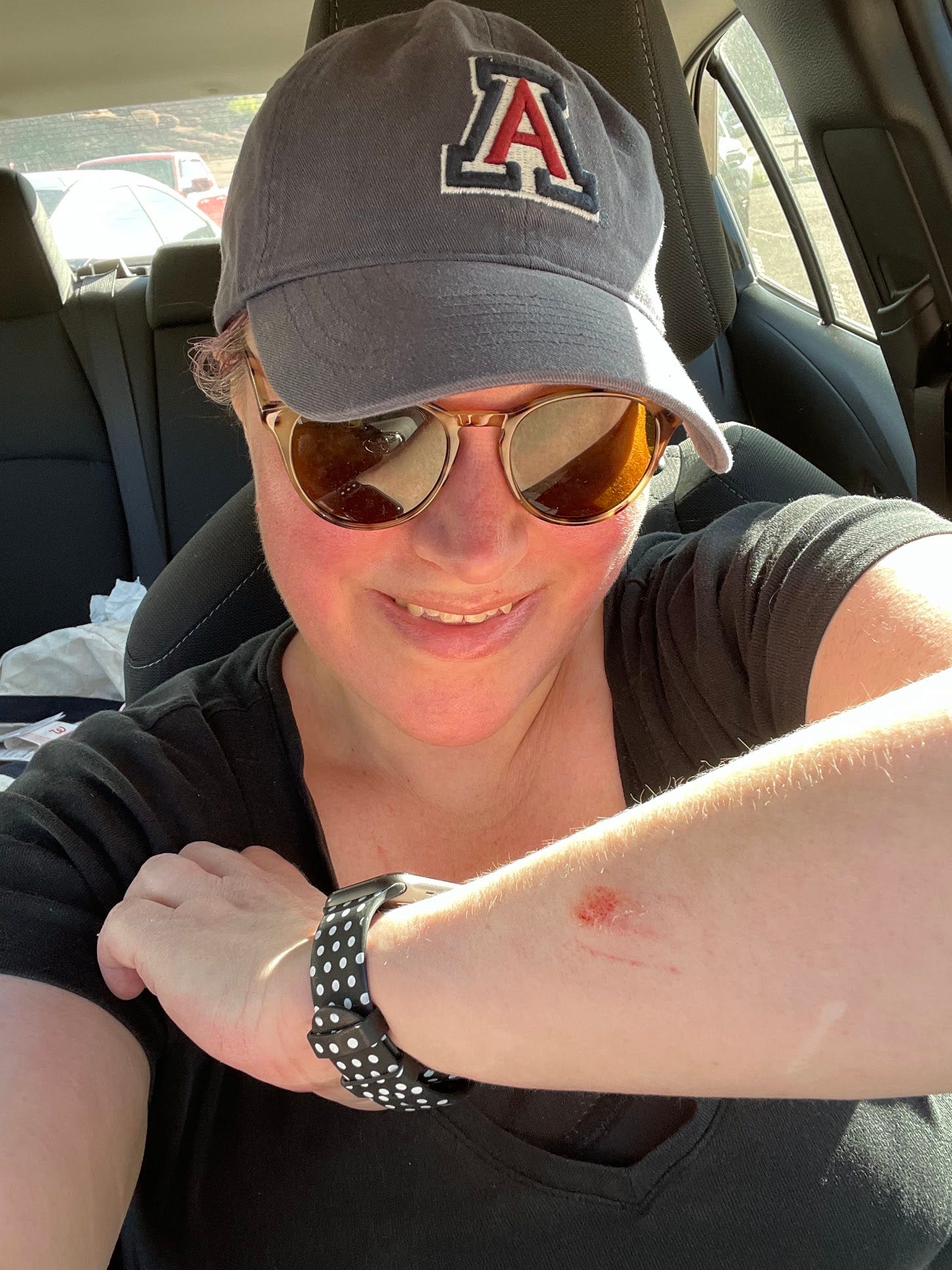 Me showing off my scraped arm.