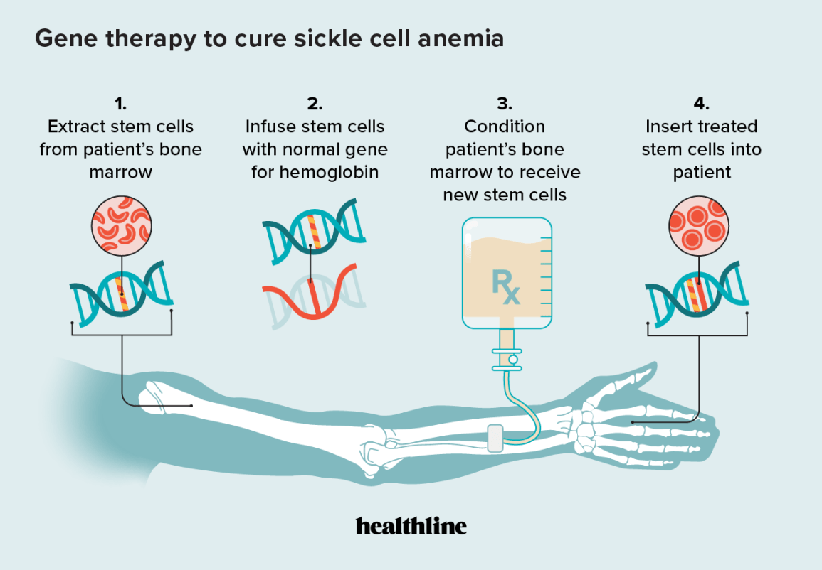 Sickle Cell Anemia and Gene Therapy: How It Works Sickle Cell Anemia and Gene Therapy: How It Works