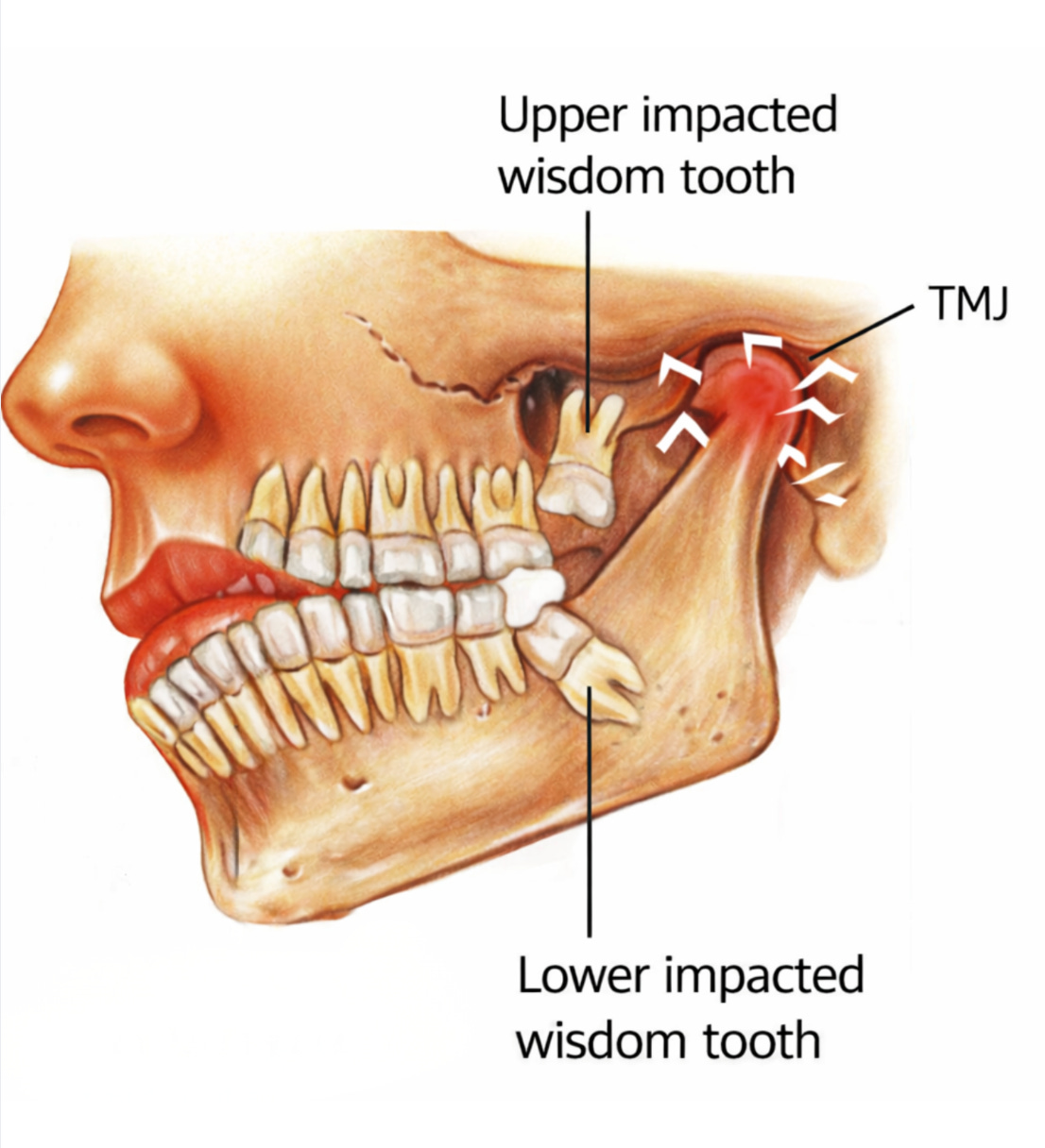 Wisdom teeth and head posture Wisdom teeth and head posture