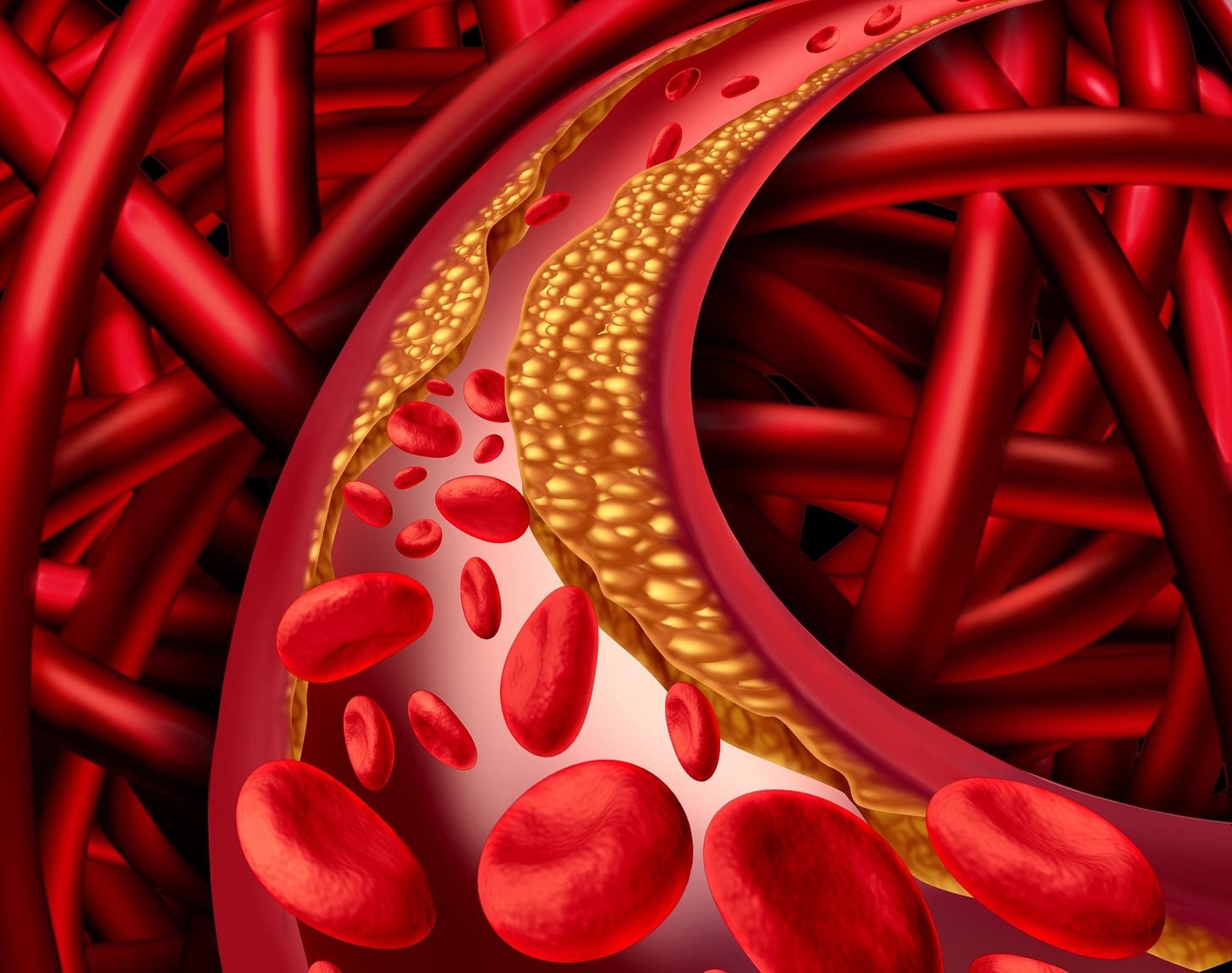 What Causes High Blood Pressure?