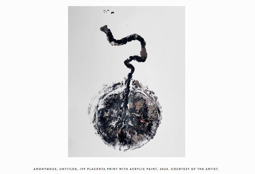 ［入手困難］ PLACENTA／CONDEMNED Placenta Model with Removable Umbilical Cord