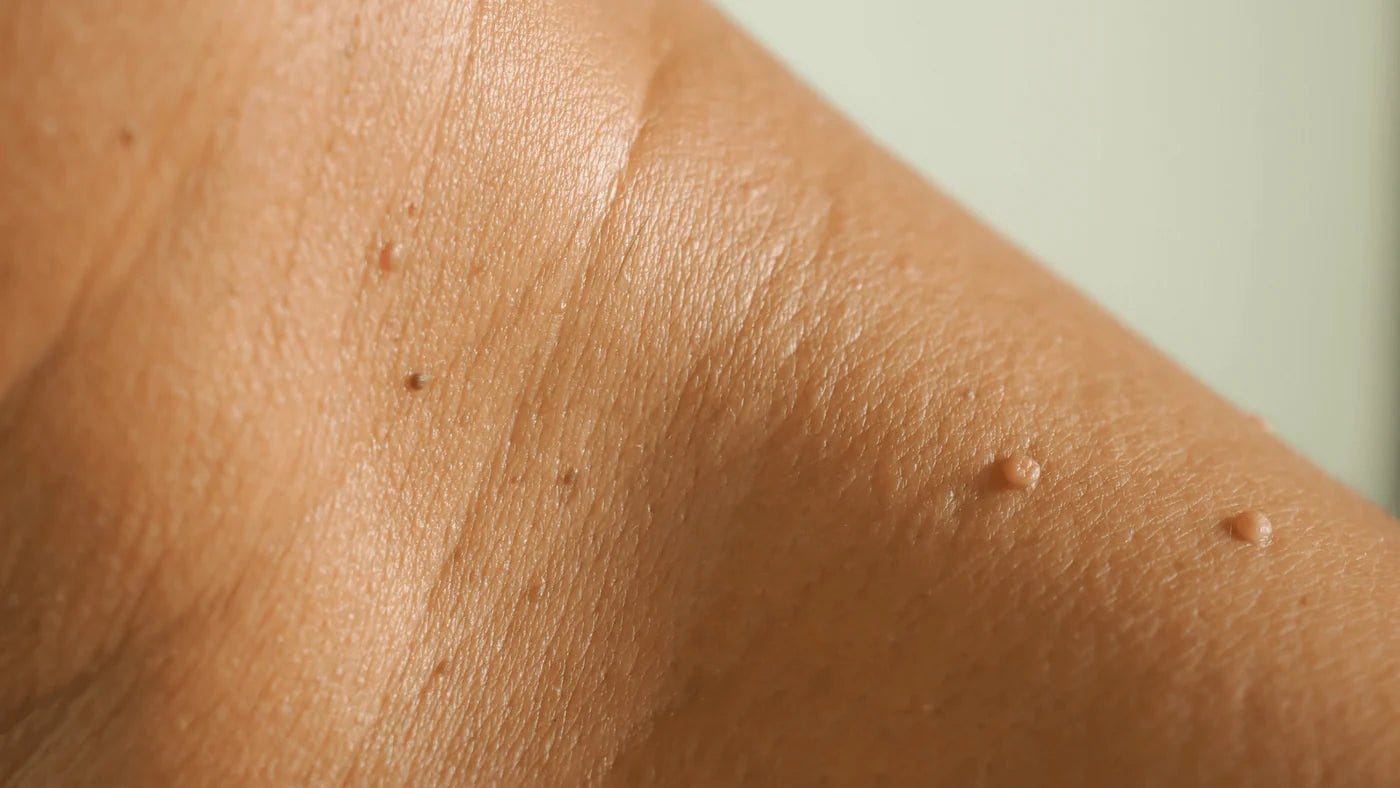 The Link Between Skin Tags and Insulin Resistance The Link Between Skin Tags and Insulin Resistance