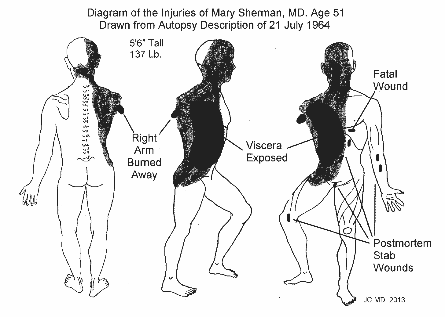 Image: https://medesignman.com/MEDICINE/THE PROJECT/The Project IMAGES/Mary Sherman Injuries Mannekin - 3 Views.gif Autopsy Diagram of Mary Sherman MD 21 July 1964