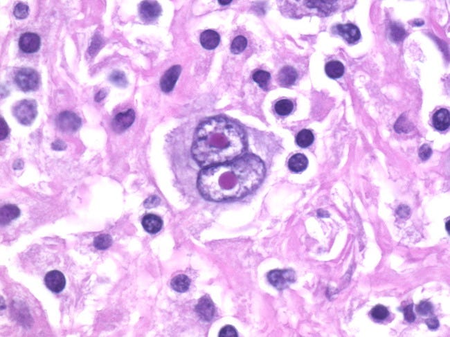 Webpathology.com: A Collection of Surgical Pathology Images